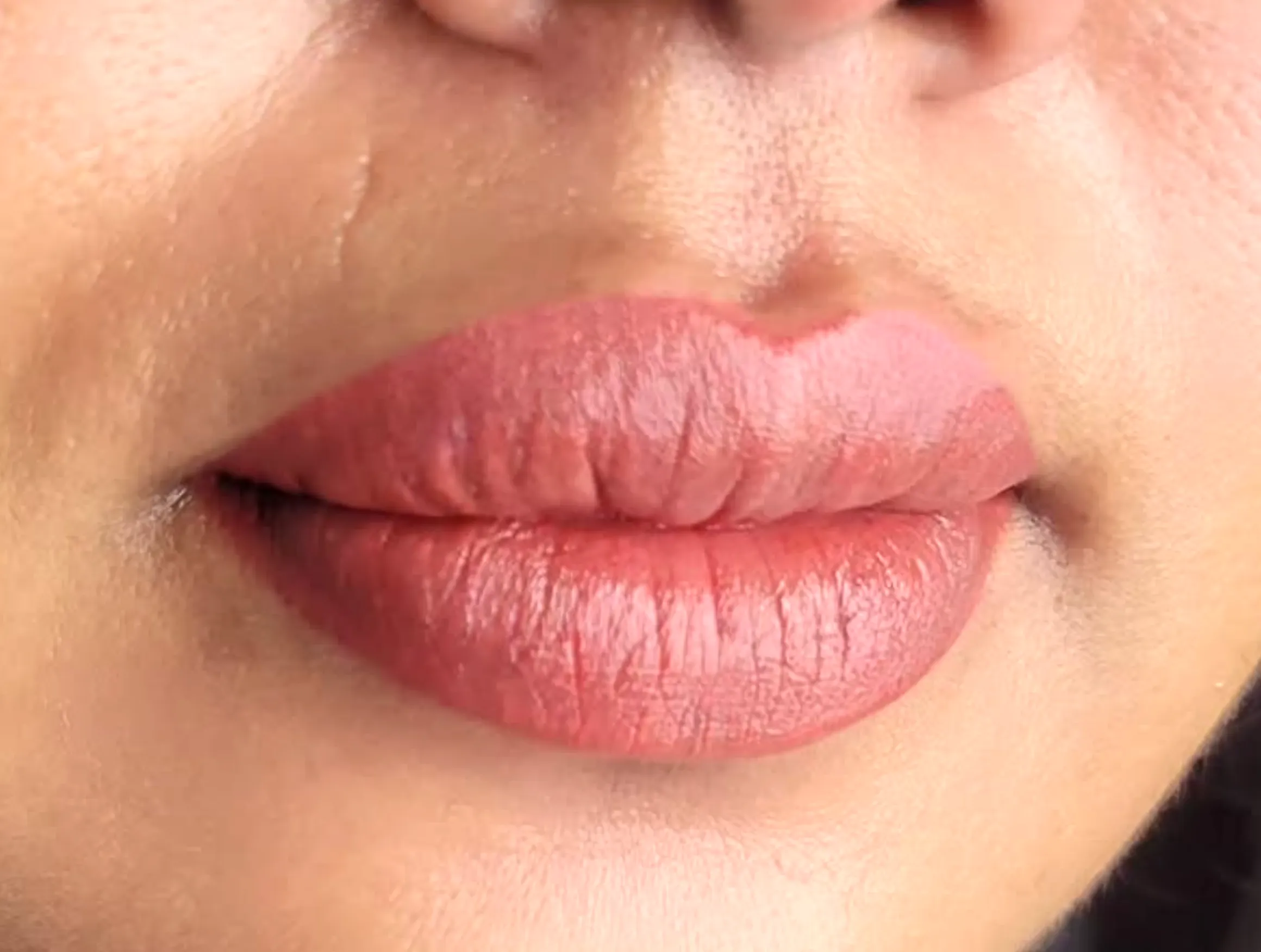 lip neutralisation technique